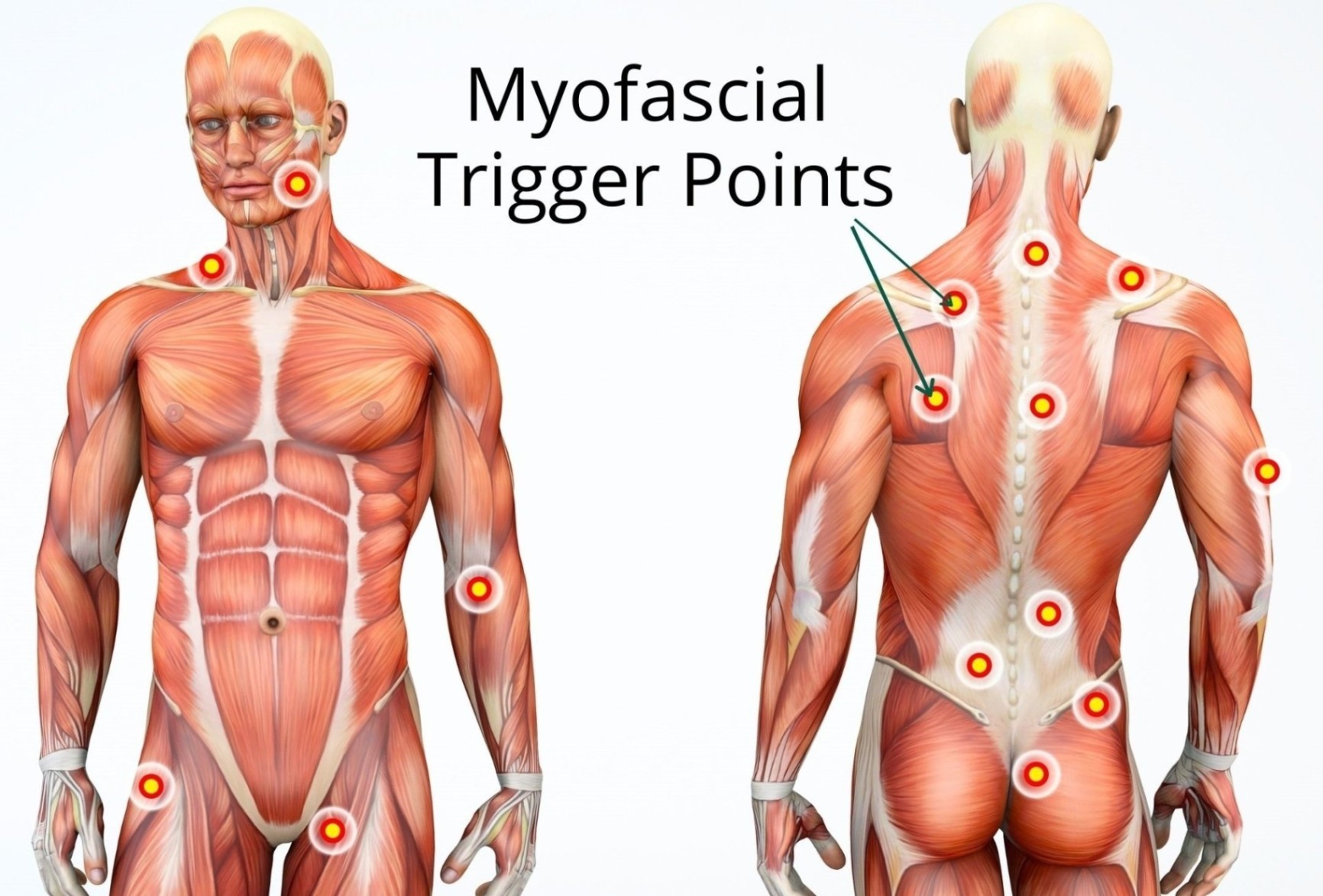 Muscle Trigger Point Anatomy - Know the Body