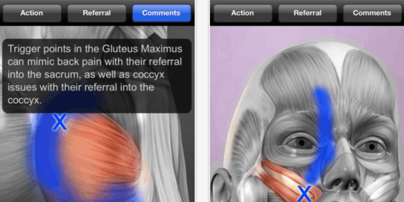 Muscle Trigger Point Anatomy - Know the Body